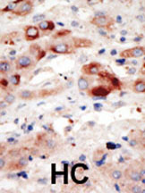 ab5451 staining PI 3 Kinase Class 3 in human hepatocarcinoma (HC) tissue by Immunohistochemistry (Formalin/PFA-fixed paraffin-embedded sections).