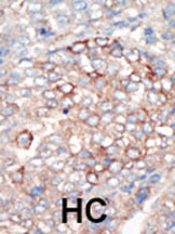 ab5459 staining PI 3 Kinase regulatory subunit 4 in human hepatocarcinoma (HC) tissue by Immunohistochemistry (Formalin/PFA-fixed paraffin-embedded sections).
