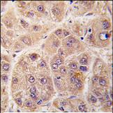 Formalin fixed and paraffin embedded human hepatocarcinoma tissue reacted with PIM3 antibody (C-term) using ab71321 at 1/50. ab71321 was peroxidase conjugated to the secondary antibody, followed by DAB staining.