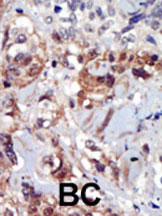 ab5469 staining PIP5K2 alpha in human breast carcinoma (BC) tissue by Immunohistochemistry (Formalin/PFA-fixed paraffin-embedded sections).