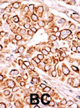 Ab60207 (1:50) staining human PIP5K3 in breast carcinoma tissue by immunohistochemistry using formalin fixed, paraffin embedded tissue. Formalin-fixed and paraffin-embedded human cancer tissue reacted with the primary antibody, which was peroxidase-conjugated to the secondary antibody, followed by AEC staining. BC = breast carcinoma.