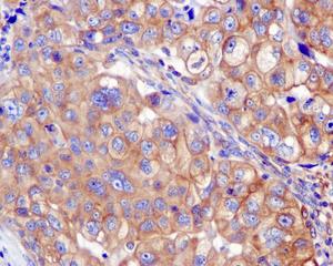 Immunohistochemical analysis of formalin-fixed, paraffin-embedded, Human breast carcinoma tissue labeling Nogo with ab180847 at a 1/50 dilution.