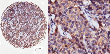 Immunohistochemistry (Formalin/PFA-fixed paraffin-embedded sections) analysis of human breast cancer tissue sections labelling NG2 with ab83508 at 1/50. 4μm-thick sections were deparaffinized in xylene, dehydrated through three alcohol changes. Endogenous peroxidase activity was quenched with 3% hydrogen peroxide in methanol. Antigen retrieval was performed in 96°C solution of 0.01 mol/L sodium citrate buffer (pH 6.0) for 30 minutes. Peroxidase/DAB, Rabbit/Mouse kit, after visualization, the sections were counterstained with hematoxylin. Hisg NG2 expression.