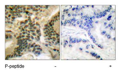 Immunohistochemical analysis of paraffin-embedded human lung carcinoma tissue using ab51166 at a 1/50 dilution.Left image un-treated.Right image treated with phosphopeptide.