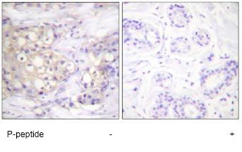 ab59365, at a 1/50 dilution, staining human PKC alpha + beta 2 in breast carcinoma, using Immunohistochemistry, Paraffin embedded tissue, in the absence of the immunizing peptide (left image) and in the presence of the immunizing peptide (right image).