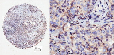 Immunohistochemistry (Formalin/PFA-fixed paraffin-embedded sections) analysis of human breast cancer tissue sections labelling NG2 with ab83508 at 1/50. 4μm-thick sections were deparaffinized in xylene, dehydrated through three alcohol changes. Endogenous peroxidase activity was quenched with 3% hydrogen peroxide in methanol. Antigen retrieval was performed in 96°C solution of 0.01 mol/L sodium citrate buffer (pH 6.0) for 30 minutes. Peroxidase/DAB, Rabbit/Mouse kit, after visualization, the sections were counterstained with hematoxylin. Low NG2 expression.