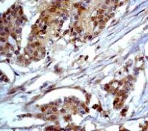 ab32026, at a 1/100 dilution, staining human PKC beta 2 in breast carcinoma by Immunohistochemistry, Paraffin embedded tissue