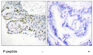 Immunohistochemistry analysis of paraffin-embedded human lung carcinoma tissue using ab74007, at 1/50 dilution, in the presence (right panel) or absence (left panel) of the immunising phophopeptide.