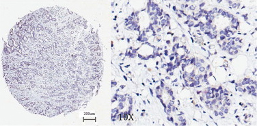 Immunohistochemistry (Formalin/PFA-fixed paraffin-embedded sections) analysis of human breast cancer tissue sections labelling NG2 with ab83508 at 1/50. 4μm-thick sections were deparaffinized in xylene, dehydrated through three alcohol changes. Endogenous peroxidase activity was quenched with 3% hydrogen peroxide in methanol. Antigen retrieval was performed in 96°C solution of 0.01 mol/L sodium citrate buffer (pH 6.0) for 30 minutes. Peroxidase/DAB, Rabbit/Mouse kit, after visualization, the sections were counterstained with hematoxylin. Negative NG2 expression.