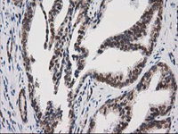 ab114034 at 1/150 dilution staining PKC epsilon in Paraffin-embedded Human Prostate carcinoma tissue by Immunohistochemistry.