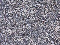 ab114034 at 1/150 dilution staining PKC epsilon in Paraffin-embedded Human Lymphoma tissue by Immunohistochemistry.