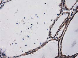 ab114020, at 1/150 dilution, staining PKC epsilon in paraffin-embedded Human thyroid tissue by Immunohistochemistry.