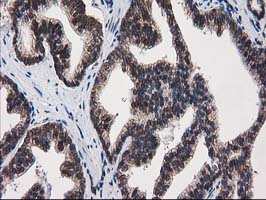 ab114020, at 1/150 dilution, staining PKC epsilon in paraffin-embedded Human prostate carcinoma tissue by Immunohistochemistry.