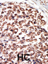 ab5286 staining PKC nu in human hepatocarcinoma(HC) tissue by Immunohistochemistry (Formalin/PFA-fixed paraffin-embedded sections).