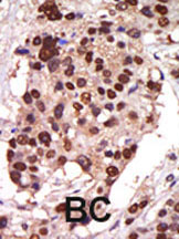 ab5285 staining PKC nu in human breast carcinoma (BC) tissue by Immunohistochemistry (Formalin/PFA-fixed paraffin-embedded sections).