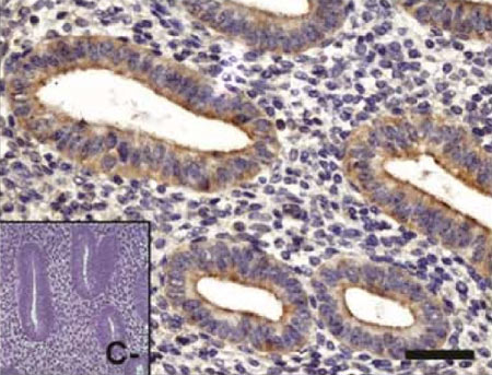 Immunohistochemical analysis of Human proliferative endometrial tissue, staining PKC zeta with ab59364. Antigen retrieval was performed by heat mediation in a citrate buffer. Tissue was blocked with blocking solution before incubating with primary antibody (1/100) overnight at 4°C. Staining was detected using DAB.