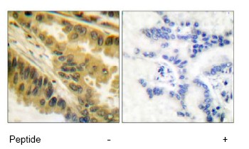 Immunohistochemical analysis of PKC zeta expression in paraffin-embedded human lung carcinoma tissue using 1/50 ab51157. Left: untreated sample. Right: sample treated with immunizing peptide (negative control).