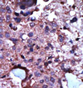 Formalin-fixed and paraffin-embedded human breast cancer tissue staineded with ab38240 at a 1/50 dilution, using a peroxidase-conjugated secondary antibody, followed by AEC staining. This data demonstrates the suitability of this antibody for immunohistochemistry; clinical relevance has not been evaluated.