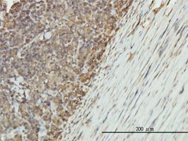 Non Neuronal Enolase antibody (ab54979) used in immunohistochemistry at 5ug/ml on formalin fixed and paraffin embedded human lymphoma tissue.
