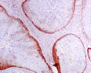 ab128994 showing positive staining in Cervical carcinoma tissue.