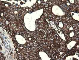 Immunohistochemical staining of paraffin-embedded Human breast adenocarcinoma tissue labelling POGK with ab139338 at 1/150 dilution.