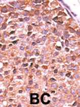 Ab60237 (1/50-1/100) staining human PPM1A in human breast carcinoma tissue by immunohistochemistry using formalin fixed, paraffin embedded tissue. Formalin-fixed and paraffin-embedded human cancer tissue reacted with the primary antibody, which was peroxidase-conjugated to the secondary antibody, followed by AEC staining. BC = breast carcinoma