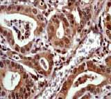 ab76574, at 1/100 dilution, staining PPM1A in paraffin-embedded human gastric carcinoma tissue by immunohistochemistry.