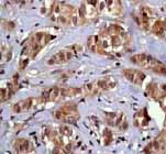 ab76574, at 1/100 dilution, staining PPM1A in paraffin-embedded human breast carcinoma tissue by immunohistochemistry.