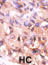 ab60234 (1/50-1/100) staining human PPM1F in human hepatocarcinoma tissue by immunohistochemistry using formalin fixed, paraffin embedded tissue. Formalin-fixed and paraffin-embedded human cancer tissue reacted with the primary antibody, which was peroxidase-conjugated to the secondary antibody, followed by AEC staining. HC = hepatocarcinoma