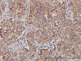PPOX antibody (ab58147) used in immunohistochemistry at 3ug/ml on formalin fixed and paraffin embedded human lung, adenosqumous cell carcinoma.