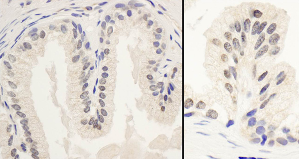 Immunohistochemistry (Formalin/PFA-fixed paraffin-embedded sections) analysis of human prostate carcinoma tissue labelling PPP1R10 with ab70247 at 1/1000 (1µg/ml). Detection: DAB.
