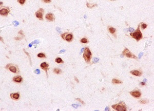 Immunohistochemical analysis of paraffin-embedded Human gliocytoma tissue labeling Nova1 using ab183024 at 1/500 dilution. A HRP conjugated Rabbit IgG was used as secondary (prediluted). Counterstain: Hematoxylin.