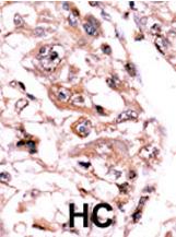 ab71457, at a 1/50 dilution, staining human PPP3CC in hepatocarcinoma, using Immunohistochemistry, Formalin/PFA fixed Paraffin embedded tissue. A peroxidase-conjugated secondary antibody was used, followed by AEC staining.