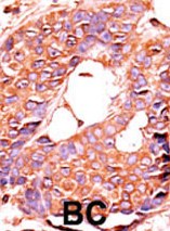 Ab60249 (1/50-1/100) staining human PPP6C in human breast carcinoma tissue by immunohsitochemistry using formalin fixed, paraffin embedded tissue. Formalin-fixed and paraffin-embedded human cancer tissue reacted with the primary antibody, which was peroxidase-conjugated to the secondary antibody, followed by AEC staining. BC = breast carcinoma