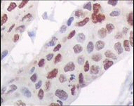 Immunohistochemical analysis of paraffin-embedded human esophagus carcinoma tissue using ab66382 at a dilution of 1/500 - 1/2000 with DAB staining, showing nuclear/cytoplasmic localization.