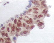 Immunohistochemical analysis of paraffin-embedded human breast carcinoma tissue using ab66382 at a dilution of 1/500 - 1/2000 with DAB staining, showing nuclear/cytoplasmic localization.