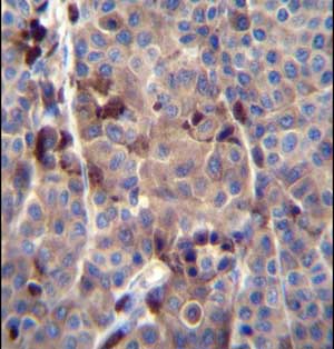 Immunohistochemical analysis of formalin fixed and paraffin embedded Human melanoma tissue labeling PRAMEF8 with ab170710 at 1/10 diution, followed by peroxidase conjugation of the secondary antibody and DAB staining.
