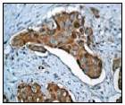 Ab51248 (1:100) staining human PRC1 in human cervical carcinoma tissue by immunohistochemistry using paraffin embedded tissue.