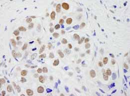 Detection of human pre-mRNA cleavage factor I (59 kDa subunit) by Immunohistochemistry.Sample: formalin fixed, paraffin embedded section of human breast carcinoma.Antibody: ab84549 used at a dilution of 1/250.Detection: DAB staining.
