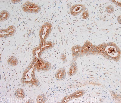 IHC image of ab85946 staining in human breast fibroadenoma formalin fixed paraffin embedded tissue section, performed on a Leica BondTM system using the standard protocol F. The section was pre-treated using heat mediated antigen retrieval with sodium citrate buffer (pH6, epitope retrieval solution 1) for 20 mins. The section was then incubated with ab85946, 1µg/ml, for 15 mins at room temperature and detected using an HRP conjugated compact polymer system. DAB was used as the chromogen. The section was then counterstained with haematoxylin and mounted with DPX. For other IHC staining systems (automated and non-automated) customers should optimize variable parameters such as antigen retrieval conditions, primary antibody concentration and antibody incubation times.