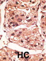 Ab38323 staining human Presenilin in human cancer tissue by immunohistochemistry using formalin fixed, paraffin embedded tissue. The primary antibody was peroxidase-conjugated to the secondary antibody, followed by AEC staining. HC = hepatocarcinoma