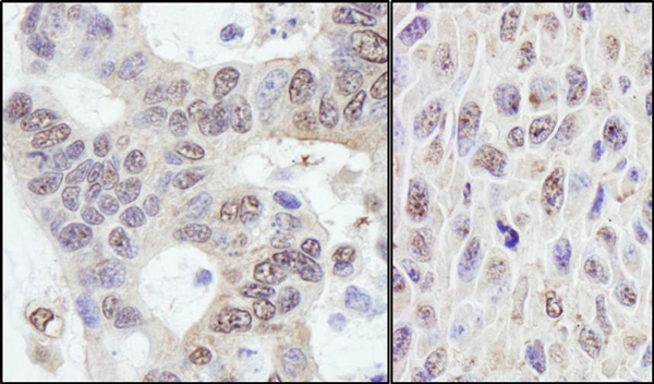 Immunohistochemistry (Formalin/PFA-fixed paraffin-embedded sections) analysis of human ovarian carcinoma (left) and mouse squamous cell carcinoma (right) tissues labelling PRKRIR with ab70334 at 1/1000 (0.2µg/ml) and 1/200 (1µg/ml). Detection: DAB.