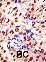 ab3763 staining PRMT2 in human breast carcinoma (BC) tissue by Immunohistochemistry (Formalin/PFA-fixed paraffin-embedded sections).
