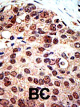 ab3765 staining PRMT3 in human breast carcinoma (BC) tissue by Immunohistochemistry (Formalin/PFA-fixed paraffin-embedded sections).