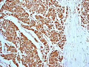 Immunohistochemistry (Formalin/PFA-fixed paraffin-embedded sections) analysis of breast carcinoma tissue labelling Prohibitin with ab75766.