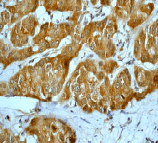 Immunohistochemistry (Formalin/PFA-fixed paraffin-embedded sections) analysis of human hepatocellular tissue labelling Prohibitin with ab75766 at 1/250.