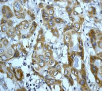 Immunohistochemistry (Formalin/PFA-fixed paraffin-embedded sections) analysis of human hepatocellular carcinoma tissue labelling Prohibitin with ab75771 at 1/100. A HRP/AP polymerized secondary antibody was used.