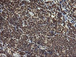 Immunohistochemical analysis of paraffin embedded Human lymphoma tissue labelling PROSC with ab131579 antibody at a dilution of 1/150.