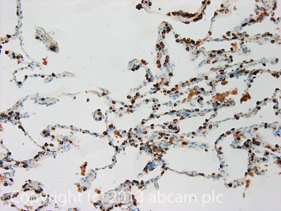 IHC image of Prosurfactant Protein C staining in Human normal lung formalin fixed paraffin embedded tissue section, performed on a Leica BondTM system using the standard protocol F. The section was pre-treated using heat mediated antigen retrieval with sodium citrate buffer (pH6, epitope retrieval solution 1) for 20 mins. The section was then incubated with ab90716, 1µg/ml, for 15 mins at room temperature and detected using an HRP conjugated compact polymer system. DAB was used as the chromogen. The section was then counterstained with haematoxylin and mounted with DPX.For other IHC staining systems (automated and non-automated) customers should optimize variable parameters such as antigen retrieval conditions, primary antibody concentration and antibody incubation times.