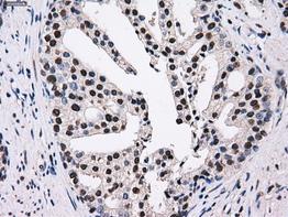 ab118009 at 1/50 dilution, staining Proteasome 26S S10 in Paraffin-embedded Human prostate carcinoma tissue Immunohistochemistry.